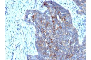 Formalin-fixed, paraffin-embedded human Ovarian Carcinoma stained with RBP1 (RBP/872) (RBP1 抗体)