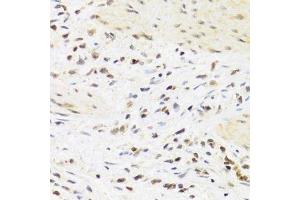 Immunohistochemistry of paraffin-embedded human breast cancer using SUMO4 Antibody. (SUMO4 抗体)