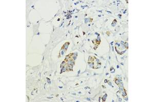 Immunohistochemistry of paraffin-embedded human mammary cancer using S1/PR antibody (ABIN6129890, ABIN6136741, ABIN6136742 and ABIN6221835) at dilution of 1:200 (40x lens).