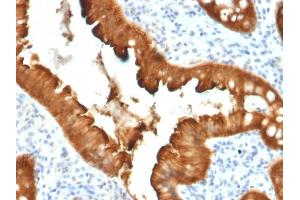 Formalin-fixed, paraffin-embedded human Colon Carcinoma stained with Villin Mouse Monoclonal Antibody (VIL1/2376). (Villin 1 抗体  (AA 179-311))