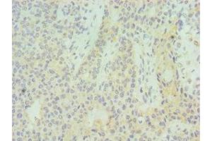 Immunohistochemistry of paraffin-embedded human breast cancer using ABIN7155529 at dilution of 1:100 (SUV39H2 抗体  (AA 201-410))