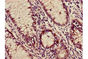Immunohistochemistry of paraffin-embedded human colon cancer using ABIN7144378 at dilution of 1:100 (AP3M2 抗体  (AA 1-273))