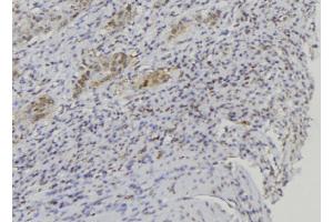 ABIN6272660 at 1/100 staining Human lung cancer tissue by IHC-P. (BPIFA1 抗体  (Internal Region))