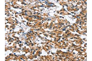 The image on the left is immunohistochemistry of paraffin-embedded Human thyroid cancer tissue using ABIN7128679(BPI Antibody) at dilution 1/50, on the right is treated with fusion protein. (BPI 抗体)