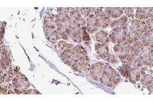 ABIN6273236 at 1/100 staining Human pancreas cancer tissue by IHC-P. (EIF2B1 抗体  (Internal Region))