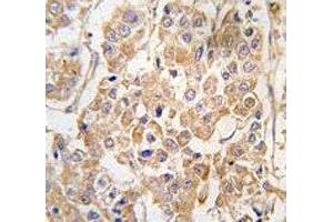 IHC analysis of FFPE human breast carcinoma tissue stained with the IKKE antibody (IKKi/IKKe 抗体  (AA 686-716))