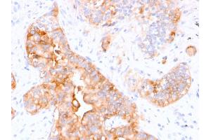 Immunohistochemistry (IHC) image for anti-Carcinoembryonic Antigen-Related Cell Adhesion Molecule 5 (CEACAM5) antibody (ABIN6939072)