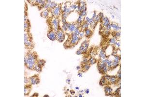 Immunohistochemistry of paraffin-embedded human liver cancer using GLUD2 antibody at dilution of 1:100 (x40 lens). (GLUD2 抗体)