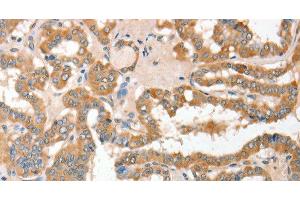 Immunohistochemistry of paraffin-embedded Human thyroid cancer using CD156c Polyclonal Antibody at dilution of 1:30 (ADAM10 抗体)