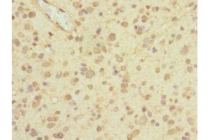 Immunohistochemistry of paraffin-embedded human glioma using ABIN7163444 at dilution of 1:100 (PIEZO1 抗体  (AA 2230-2420))
