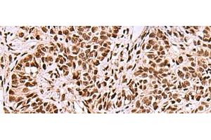 Immunohistochemistry of paraffin-embedded Human ovarian cancer tissue using FOXK2 Polyclonal Antibody at dilution of 1:50(x200) (Forkhead Box K2 抗体)