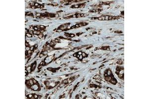Immunohistochemical staining (Formalin-fixed paraffin-embedded sections) of human breast cancer with MTDH monoclonal antibody, clone CL0397  shows strong cytoplasmic immunoreactivity in cancer cells. (MTDH 抗体)