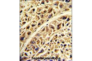 Formalin-fixed and paraffin-embedded human hepatocarcinoma with PRELP Antibody , which was peroxidase-conjugated to the secondary antibody, followed by DAB staining. (PRELP 抗体  (C-Term))
