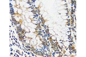 Immunohistochemistry of paraffin-embedded Human colon using CCDC124 Polyclonal Antibody at dilution of 1:100 (40x lens). (CCDC124 抗体)