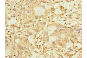 Immunohistochemistry of paraffin-embedded human pancreatic cancer using ABIN7146024 at dilution of 1:100 (SPAG9 抗体  (N-Term))