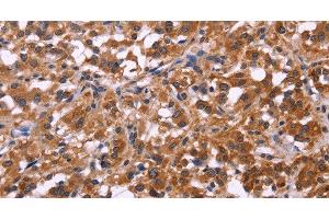 Immunohistochemistry of paraffin-embedded Human thyroid cancer tissue using SPATA7 Polyclonal Antibody at dilution 1:30 (SPATA7 抗体)