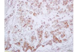Formalin-fixed and paraffin embedded human liver carcinoma labeled with Anti-Phospho-PKM2 (Tyr105) Polyclonal Antibody, Unconjugated (ABIN744773) at 1:200 followed by conjugation to the secondary antibody and DAB staining (PKM2 抗体  (pTyr105))