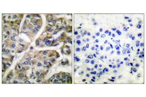 Immunohistochemical analysis of paraffin-embedded human breast carcinoma tissue using Granzyme B antibody (ABIN2843546). (GZMB 抗体  (N-Term))