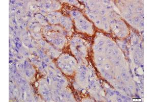 Formalin-fixed and paraffin embedded human laryngocarcinoma labeled with Anti-EGFRvIII Polyclonal Antibody, Unconjugated  at 1:200 followed by conjugation to the secondary antibody and DAB staining (EGFRviii 抗体  (AA 1-50))