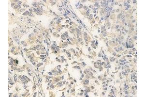 ABIN6260726 and ABIN6266946 at 1/100 staining human lung squamous cell carcinoma by IHC-P. (CDKL4 抗体  (Internal Region))