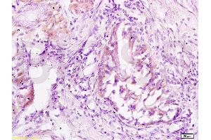Formalin-fixed and paraffin embedded: human lung carcinoma labeled with Anti-JNK1/3 Polyclonal Antibody (ABIN669381), Unconjugated at 1:200 followed by conjugation to the secondary antibody and DAB staining (JNK 抗体  (AA 201-300))