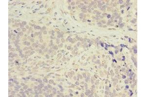 Immunohistochemistry of paraffin-embedded human gastric cancer using ABIN7143283 at dilution of 1:100 (ADA 抗体  (AA 157-343))