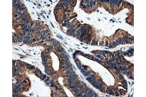 Immunohistochemical staining of paraffin-embedded liver tissue using anti-SRRmouse monoclonal antibody. (SRR 抗体)