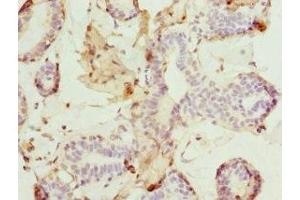 Immunohistochemistry of paraffin-embedded human breast cancer using ABIN7165308 at dilution of 1:100 (DR1 抗体  (AA 1-176))