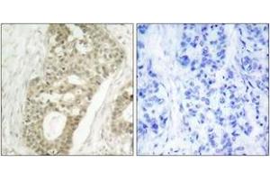 Immunohistochemistry analysis of paraffin-embedded human breast carcinoma, using PKC delta (Phospho-Ser645) Antibody. (PKC delta 抗体  (pSer645))