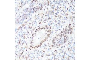 Immunohistochemistry of paraffin-embedded human appendix using P-MYC-S62 antibody (ABIN3019544, ABIN3019545, ABIN3019546 and ABIN6225456) at dilution of 1:100 (40x lens). (c-MYC 抗体  (pSer62))