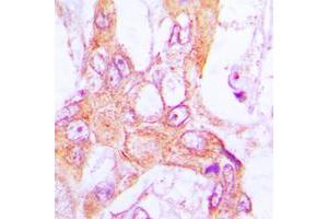 Immunohistochemical analysis of PDLIM1 staining in human lung cancer formalin fixed paraffin embedded tissue section. (PDLIM1 抗体  (Center))