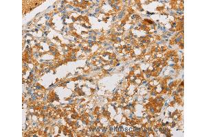 Immunohistochemistry of Human lung cancer using ART3 Polyclonal Antibody at dilution of 1:40 (ART3 抗体)