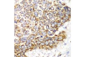 Immunohistochemistry of paraffin-embedded human esophageal cancer using TFAM antibody. (TFAM 抗体  (AA 1-220))