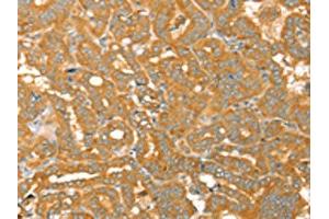The image on the left is immunohistochemistry of paraffin-embedded Human thyroid cancer tissue using ABIN7130772(PTPN22 Antibody) at dilution 1/30, on the right is treated with fusion protein. (PTPN22 抗体)