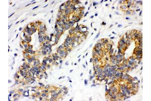 Anti- Integrin alpha 4 Picoband antibody, IHC(P) IHC(P): Human Mammary Cancer Tissue (ITGA4 抗体  (C-Term))
