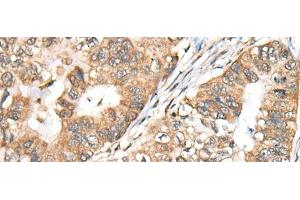 Immunohistochemistry of paraffin-embedded Human gastric cancer tissue using BLNK Polyclonal Antibody at dilution of 1:40(x200) (B-Cell Linker 抗体)