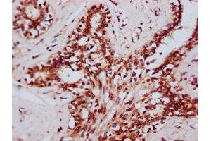 IHC image of ABIN7164169 diluted at 1:400 and staining in paraffin-embedded human breast cancer performed on a Leica BondTM system. (DHX38 抗体  (AA 113-280))