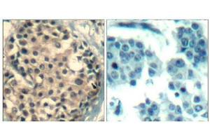 Immunohistochemical analysis of paraffin-embedded human breast carcinoma tissue using HDAC4/HDAC5/HDAC9(Phospho-Ser246/259/220) Antibody(left) or the same antibody preincubated with blocking peptide(right). (HDAC4/HDAC5/HDAC9 抗体  (pSer220, pSer246, pSer259))