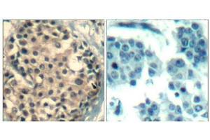 Immunohistochemical analysis of paraffin-embedded human breast carcinoma tissue using HDAC4/HDAC5/HDAC9(Phospho-Ser246/259/220) Antibody(left) or the same antibody preincubated with blocking peptide(right). (HDAC4/HDAC5/HDAC9 抗体  (pSer220, pSer246, pSer259))
