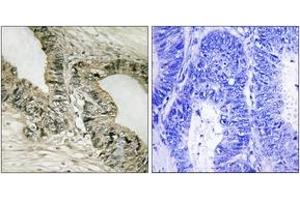 Immunohistochemistry analysis of paraffin-embedded human colon carcinoma tissue, using Gab2 (Ab-159) Antibody. (GAB2 抗体  (AA 125-174))