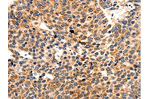 The image on the left is immunohistochemistry of paraffin-embedded Human liver cancer tissue using ABIN7191765(PAFAH1B1 Antibody) at dilution 1/25, on the right is treated with synthetic peptide. (PAFAH1B1 抗体)