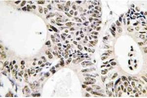 Immunohistochemistry (IHC) analyzes of p53 antibody in paraffin-embedded human colon carcinoma tissue. (p53 抗体)