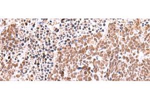 Immunohistochemistry of paraffin-embedded Human lung cancer tissue using RCOR3 Polyclonal Antibody at dilution of 1:60(x200) (RCOR3 抗体)