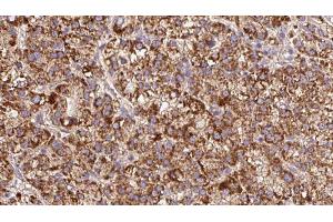 ABIN6279611 at 1/100 staining Human liver cancer tissue by IHC-P. (GPM6A 抗体  (Internal Region))