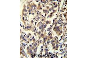 CCDC110 Antibody (C-term) immunohistochemistry analysis in formalin fixed and paraffin embedded human testis carcinoma followed by peroxidase conjugation of the secondary antibody and DAB staining. (CCDC110 抗体  (C-Term))