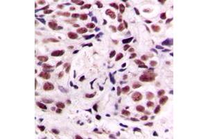 Immunohistochemical analysis of CREB (pS133) staining in human breast cancer formalin fixed paraffin embedded tissue section. (CREB1 抗体  (pSer133))