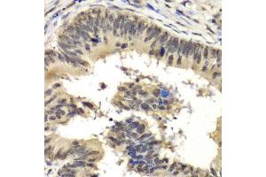 Immunohistochemistry of paraffin-embedded human colon carcinoma using RBBP5 antibody. (RBBP5 抗体  (AA 319-538))