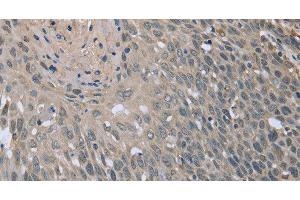 Immunohistochemistry of paraffin-embedded Human cervical cancer tissue using BMX Polyclonal Antibody at dilution 1:30 (BMX 抗体)