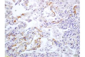 Formalin-fixed and paraffin embedded human lung carcinoma labeled with Anti Integrin alpha V/CD51 Polyclonal Antibody (ABIN678983), Unconjugated at 1:200, followed by conjugation to the secondary antibody and DAB staining (CD51 抗体  (AA 51-150))