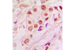 Immunohistochemical analysis of DJ-1 staining in human lung cancer formalin fixed paraffin embedded tissue section. (PARK7/DJ1 抗体  (Center))